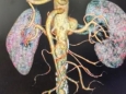 区内首例独立完成！血管介入外科在3D影像融合引导下腹主动脉四分支腔内重建治疗复杂腹主动脉瘤