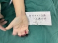 不幸！男子被机器切断4根手指，万幸！工医专家6小时再植成功！
