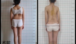 女孩脊柱侧弯达100度！柳工医让她重新挺直“脊梁”，专家提醒……