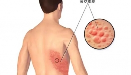 带状疱疹后遗神经痛不要怕！针灸治疗有妙招