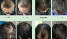 工医科普 | 秃头了，植发就可以一劳永逸吗？