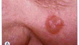 健康科普｜新发“痣”没在意，一查竟是皮肤癌！