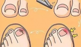 工医科普 | 别让“甲沟炎”阻碍了奔跑的脚步