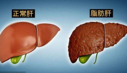 工医科普 | 超声医师带你了解脂肪肝