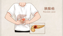 挑战普外手术“天花板——我院肝胆外科成功完成高难度胰十二指肠切除术