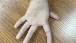 食指变“拇指”，“漂浮拇”男孩术后活动自如，专家提醒……