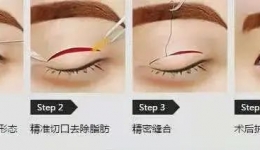 暑期想割双眼皮，请先揣好这篇科普（文末有福利）