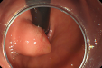 镜到病除——ESD术切除贲门“巨大”肿物