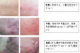 招募中重度痤疮患者参与研究，免费名额速抢！