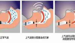 打鼾是病，得治！