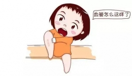 爬满“蚯蚓”的小腿终于有救了……