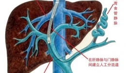 区内首例！血管介入外科联合介入治疗室3D融合技术助力TIPS术成功高效开展