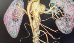 区内首例独立完成！血管介入外科在3D影像融合引导下腹主动脉四分支腔内重建治疗复杂腹主动脉瘤