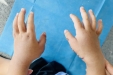 男孩天生12根手指，医生呼吁：“多指畸形”越早手术效果越好！