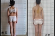 女孩脊柱侧弯达100度！柳工医让她重新挺直“脊梁”，专家提醒……