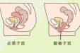 “掉”下来的尴尬——盆腔脏器脱垂