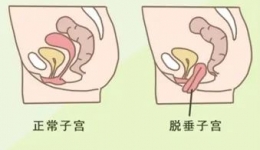 “掉”下来的尴尬——盆腔脏器脱垂