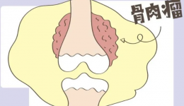 工医云课堂 | 隐藏在青少年生长痛中的“凶手”——骨肉瘤