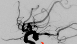 跨域精准救治 | 柳州市工人医院成功救治七旬复杂脑血管病患者