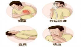 慢病科普知识系列⑪ | 别让血栓“栓”住你