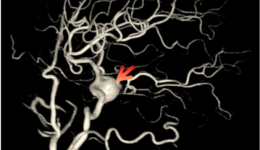 巧拆颅内“定时炸弹” | 柳州市工人医院成功为贫困患者实施颅内宽颈动脉瘤介入手术
