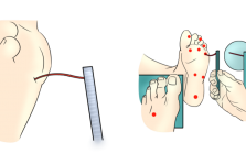 慢病科普知识系列⑫ | 糖尿病足全攻略：别让双脚悄悄受伤！
