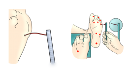 慢病科普知识系列⑫ | 糖尿病足全攻略：别让双脚悄悄受伤！